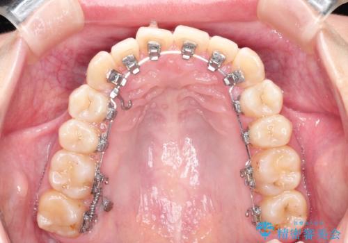 ハーフリンガル ワイヤー矯正による非抜歯・過蓋咬合の治療の治療中