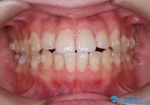 前歯がガタガタ・噛み切りにくい インビザラインによる歯を抜かない矯正の治療中