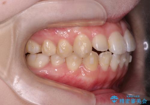 前歯がガタガタ・噛み切りにくい インビザラインによる歯を抜かない矯正の治療中