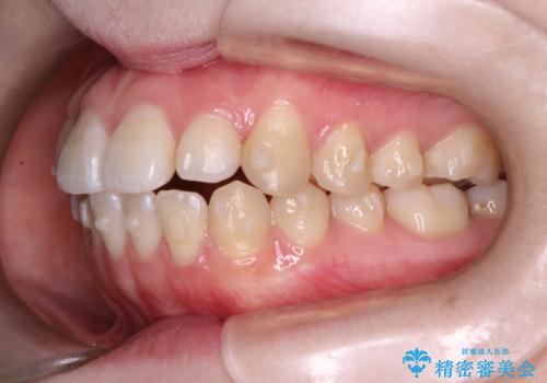 前歯がガタガタ・噛み切りにくい インビザラインによる歯を抜かない矯正の治療中