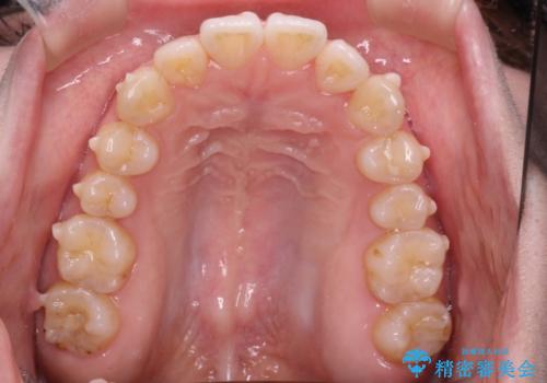 前歯がガタガタ・噛み切りにくい インビザラインによる歯を抜かない矯正の治療中