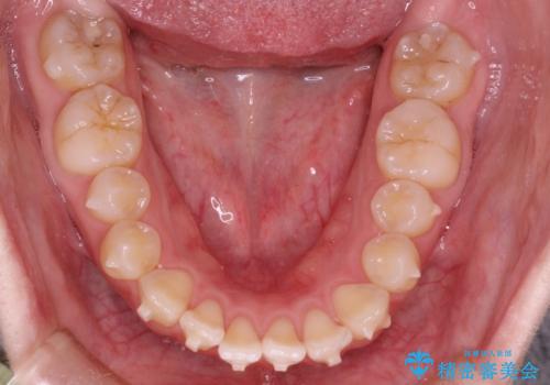 前歯がガタガタ・噛み切りにくい　インビザラインによる歯を抜かない矯正の治療中