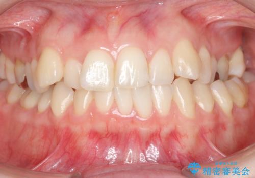 抜かない、削らない矯正 大人も上顎を骨から広げますの症例 治療前