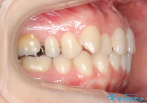 抜かない、削らない矯正 大人も上顎を骨から広げますの治療前