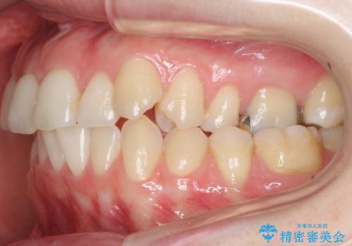 抜かない、削らない矯正 大人も上顎を骨から広げますの治療前