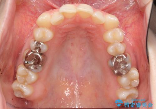 抜かない、削らない矯正 大人も上顎を骨から広げますの治療前