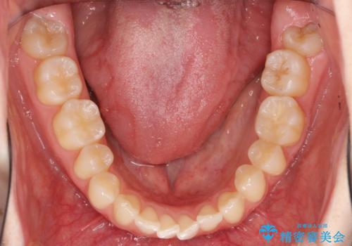 抜かない、削らない矯正 大人も上顎を骨から広げますの治療前