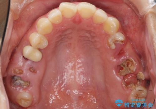 自家歯牙移植 使っていない親知らずを移植 20代女性の治療前