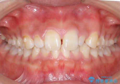 前歯のすきま 矯正治療とセラミックで小さな歯を形良くの治療中