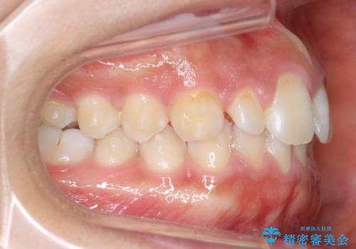 前歯のすきま 矯正治療とセラミックで小さな歯を形良くの治療中