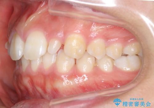 前歯のすきま 矯正治療とセラミックで小さな歯を形良くの治療中