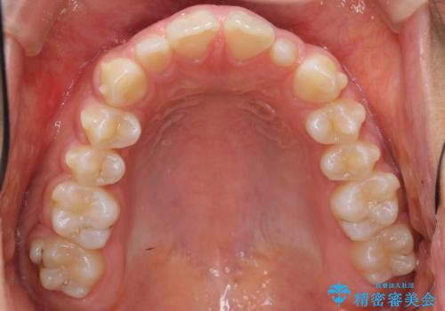 前歯のすきま　矯正治療とセラミックで小さな歯を形良くの治療中