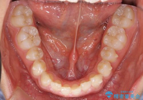 前歯のすきま　矯正治療とセラミックで小さな歯を形良くの治療中