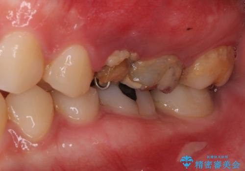 異臭のする歯を抜歯　奥歯のセラミックブリッジ治療の治療前