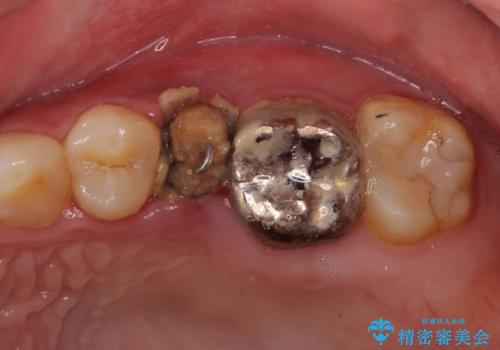 異臭のする歯を抜歯 奥歯のセラミックブリッジ治療の治療前