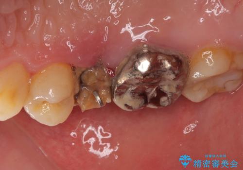 異臭のする歯を抜歯　奥歯のセラミックブリッジ治療の治療前