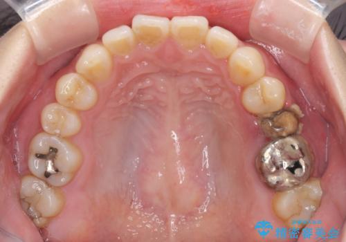 異臭のする歯を抜歯 奥歯のセラミックブリッジ治療の治療前