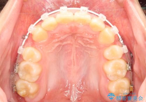抜歯矯正で口元に変化を ラビアル・ワイヤー矯正でEラインの治療中