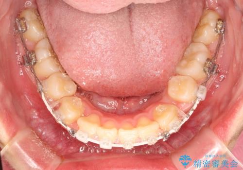 抜歯矯正で口元に変化を ラビアル・ワイヤー矯正でEラインの治療中
