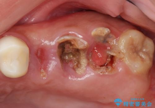 自家歯牙移植 使っていない親知らずを移植 20代女性の症例 治療前