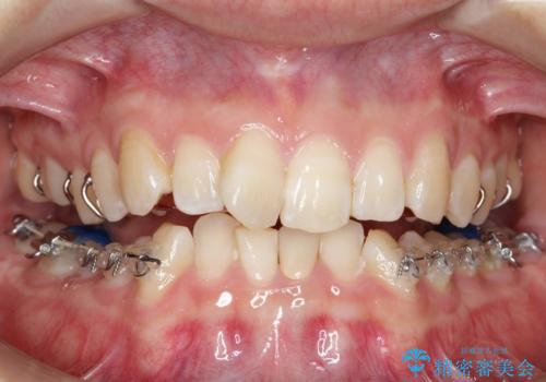 ハーフリンガル ワイヤー矯正による非抜歯・過蓋咬合の治療の治療中