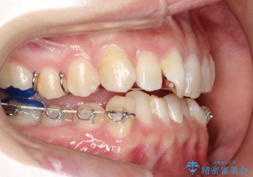 ハーフリンガル ワイヤー矯正による非抜歯・過蓋咬合の治療の治療中