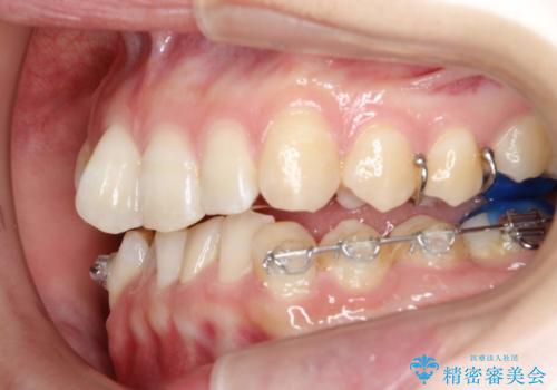 ハーフリンガル ワイヤー矯正による非抜歯・過蓋咬合の治療の治療中