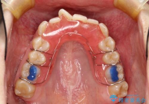 ハーフリンガル ワイヤー矯正による非抜歯・過蓋咬合の治療の治療中
