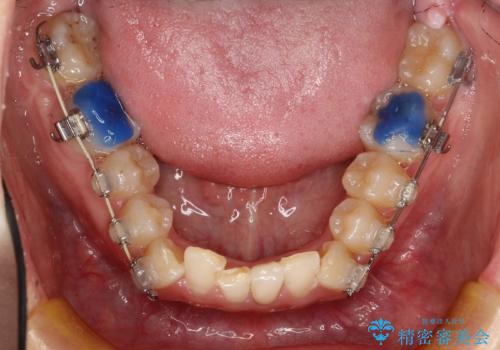 ハーフリンガル　ワイヤー矯正による非抜歯・過蓋咬合の治療の治療中
