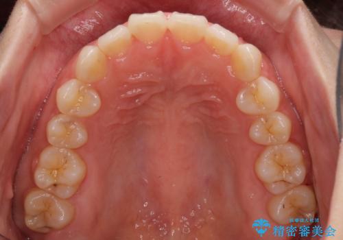 前歯のデコボコを治したい インビザラインによる矯正治療の治療中