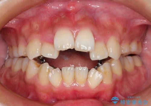 人生が変わる　困難を極める咬合状態に歯列矯正単独で挑戦するの治療中