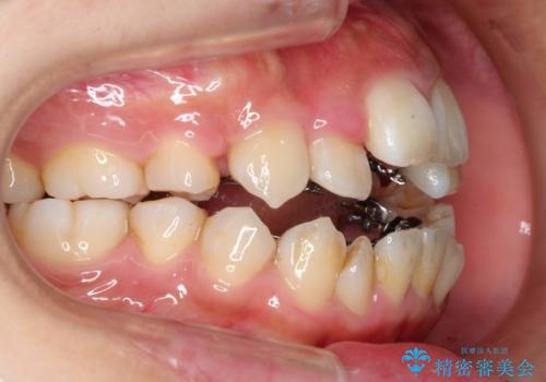 人生が変わる 困難を極める咬合状態に歯列矯正単独で挑戦するの治療中