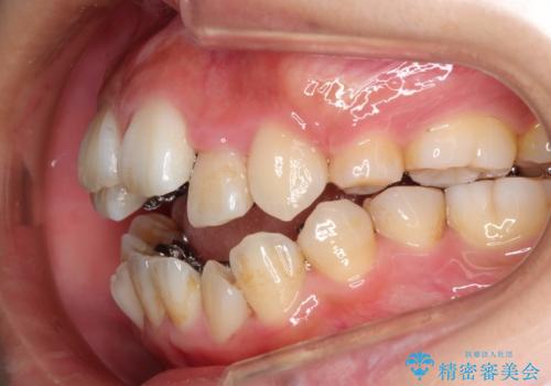 人生が変わる　困難を極める咬合状態に歯列矯正単独で挑戦するの治療中