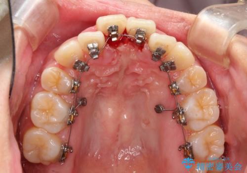 人生が変わる 困難を極める咬合状態に歯列矯正単独で挑戦するの治療中