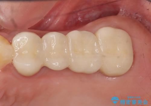 自家歯牙移植 使っていない親知らずを移植 20代女性の症例 治療後