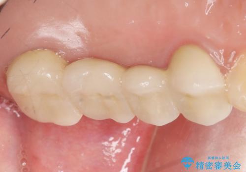 自家歯牙移植 使っていない親知らずを移植 20代女性の治療後