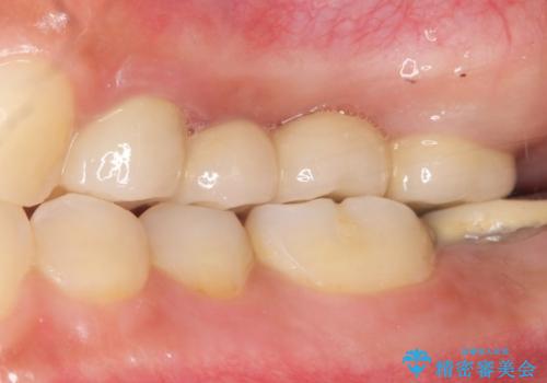 自家歯牙移植 使っていない親知らずを移植 20代女性の治療後