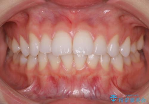インビザラインで出っ歯を改善する　抜歯をしないinvisalign治療の治療前