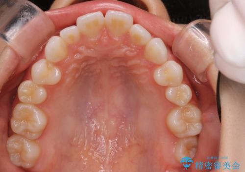 インビザラインで出っ歯を改善する　抜歯をしないinvisalign治療の治療前