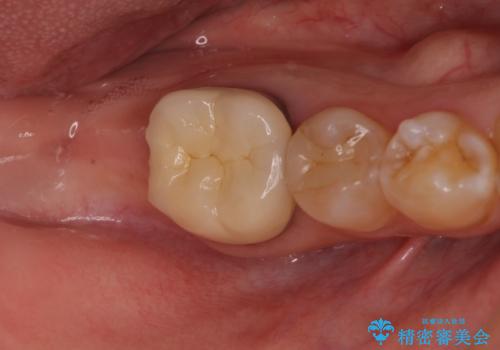 部分矯正を併用した、ストローマンインプラントによる奥歯の咬合回復の治療中