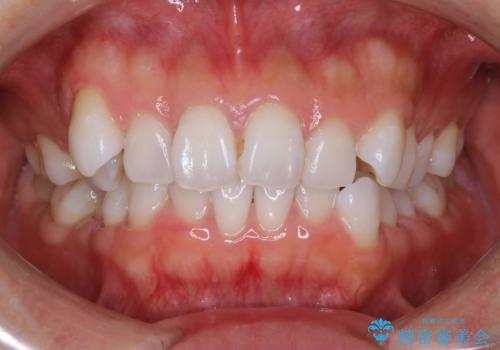 抜歯せずに八重歯のマウスピース矯正の治療前