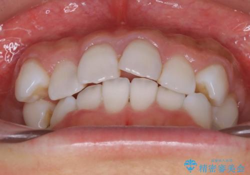抜歯せずに八重歯のマウスピース矯正の治療前