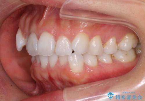 抜歯せずに八重歯のマウスピース矯正の治療前