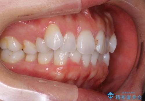 抜歯せずに八重歯のマウスピース矯正の治療前