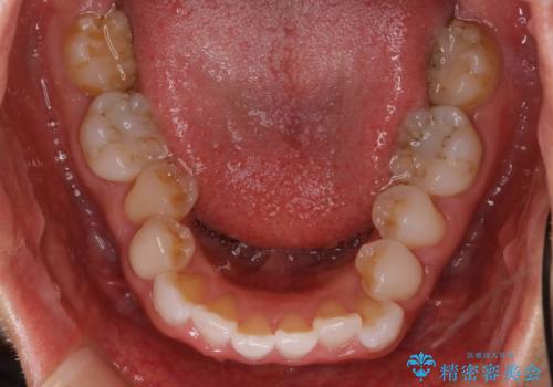 抜歯せずに八重歯のマウスピース矯正の治療前