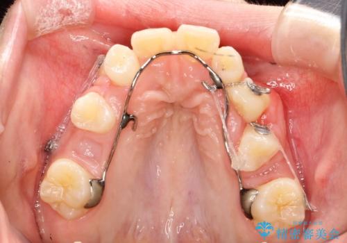永久歯が生えてこない　ワイヤー矯正で複雑な状態を正常咬合へ誘導する