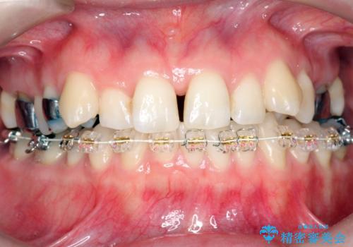 抜かない、削らない矯正 大人も上顎を骨から広げますの治療中