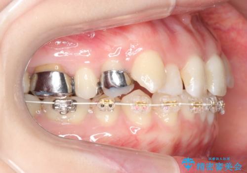 抜かない、削らない矯正 大人も上顎を骨から広げますの治療中