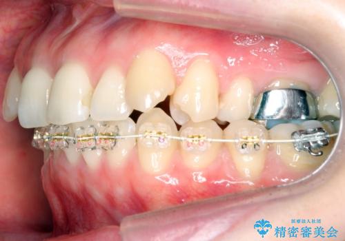 抜かない、削らない矯正 大人も上顎を骨から広げますの治療中