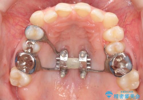 抜かない、削らない矯正 大人も上顎を骨から広げますの治療中